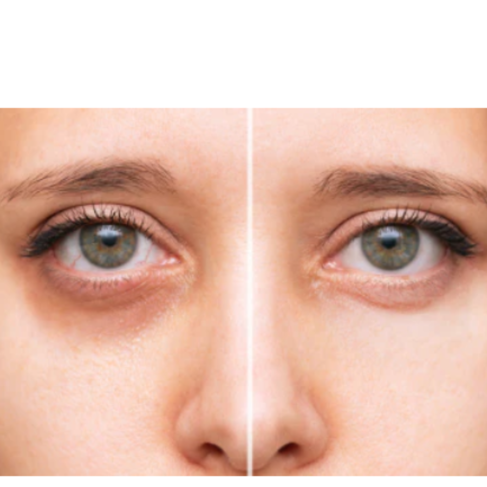 “Despídete de bolsas y ojeras en 2–4 semanas, sin tratamientos caros ni agujas”