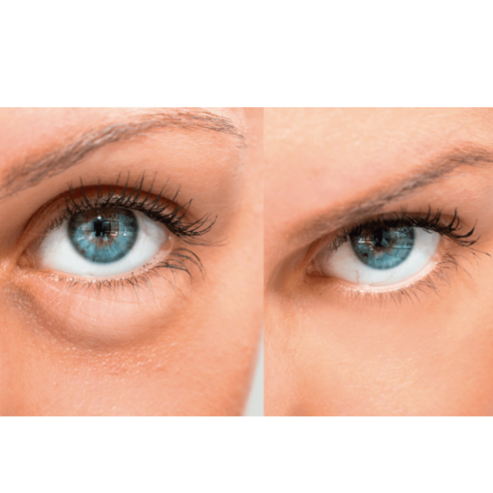 “Despídete de bolsas y ojeras en 2–4 semanas, sin tratamientos caros ni agujas”